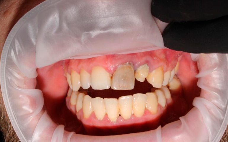 Terapia-Periodontal